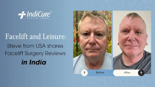 Facelift surgery reviews in India Facelift surgery reviews in India